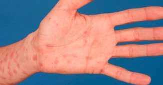 Streamline: Congenital Syphilis on the Rise, Requires Increase in Index of Suspicion